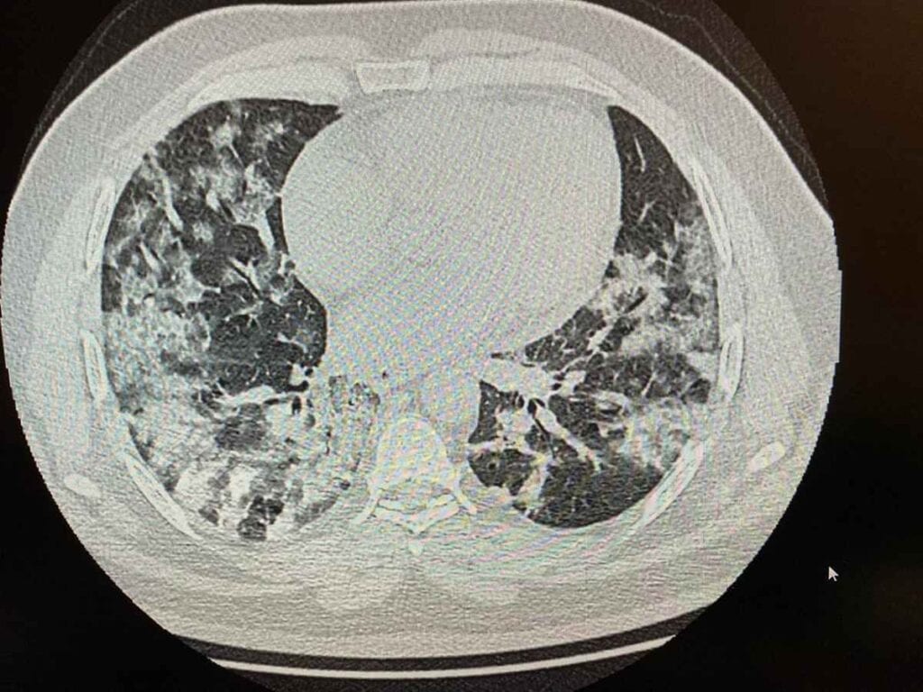 Imagini de groază cu plămânii unui pacient COVID. Medic: Cum facem cu ei domnule doctor Bittman, doamnă doctor Corina Chiriac?”